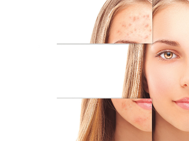 Rostro sin acné | SkinNews Revista Dermocosmética