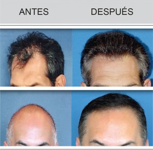 transpel-alopecia-androgenetica-2