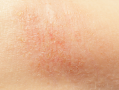 m35DCILz-photo-eczema-3-s-