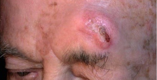 Cancerul de piele - cauze, diagnostic si tratament