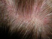 Alopecia central centrífuga.