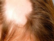 Alopecia Cicatrizal