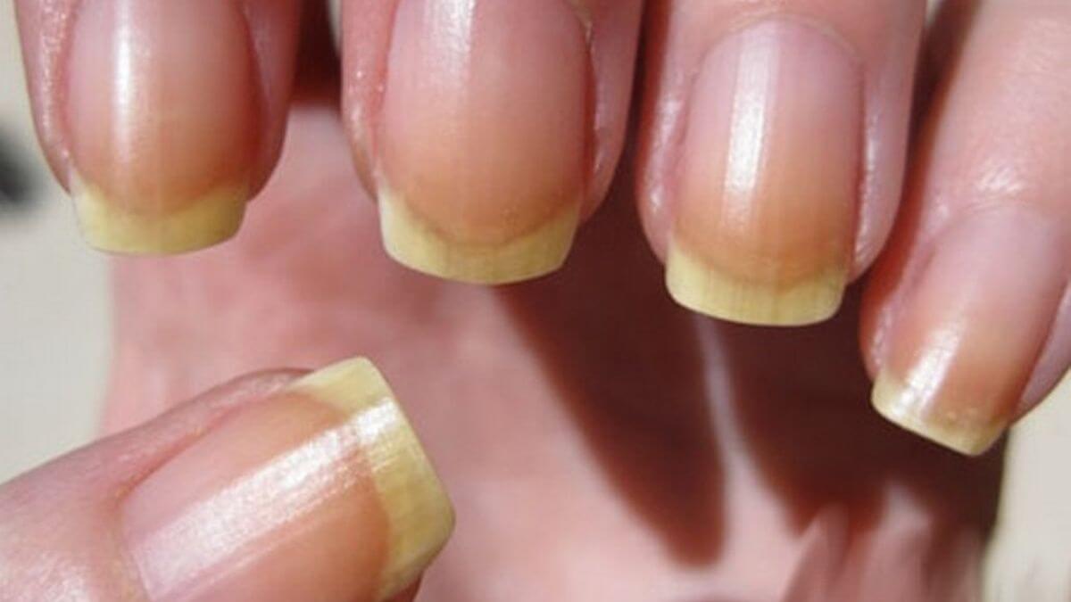 Los 10 comunes en las uñas | SkinNews Revista