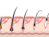 transpel-alopecia-androgenetica