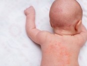 Enfermedades transitorias de la piel en recién nacidos