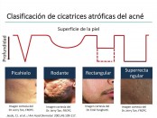 Opciones de tratamiento en cicatrices de acné